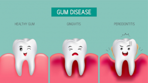 How long can you keep your teeth with periodontal disease