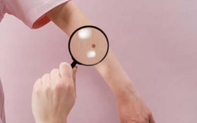 5 Common Concerns Answered About Skin Cancer Checks in Adelaide for Families